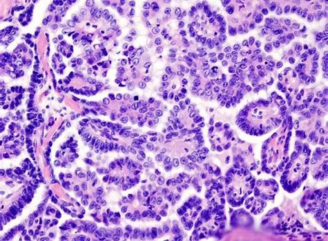 CancerRes：新研究发现帮助清除癌症干细胞的新靶标